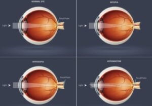 common-eye-refractive-conditions-optometrists-paarl-oogkundige-marelise-bester-main-road-paarl