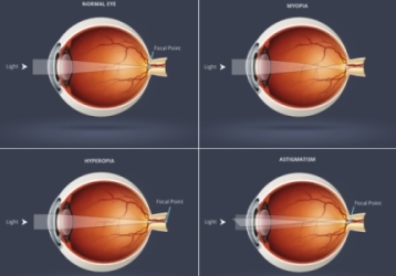 common-eye-refractive-conditions-optometrists-paarl-oogkundige-marelise-bester-main-road-paarl